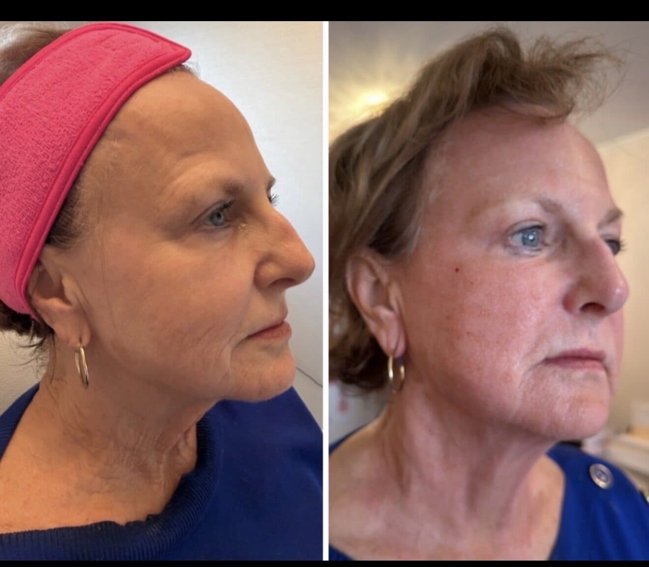 HELIX DEKA FUSION + CO2 Resurfacing