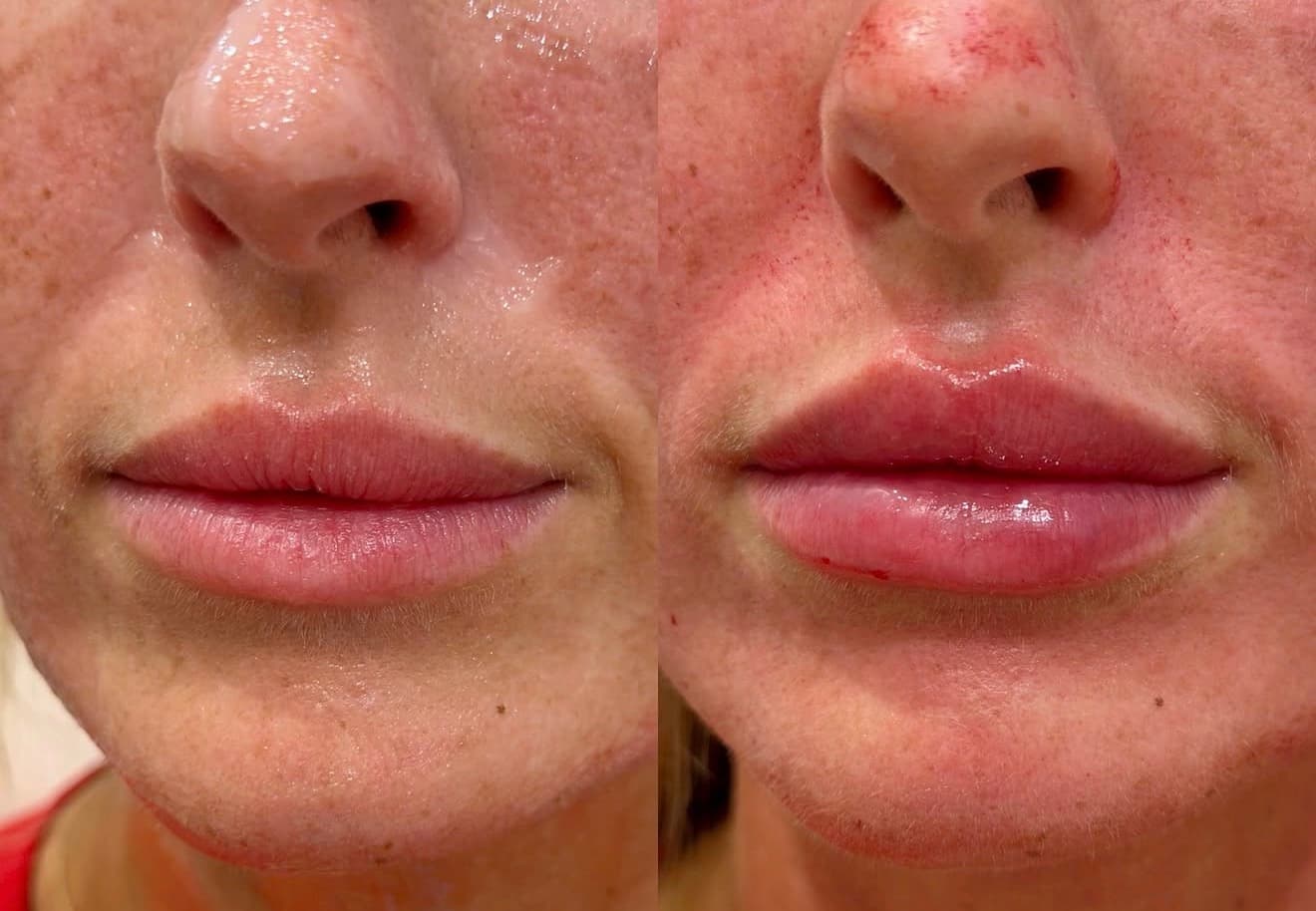 Microneedling + Lip Filler